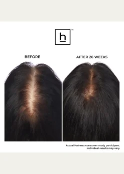 HairmaxLaserBand 82 ComfortFlex Hair Growth Device
